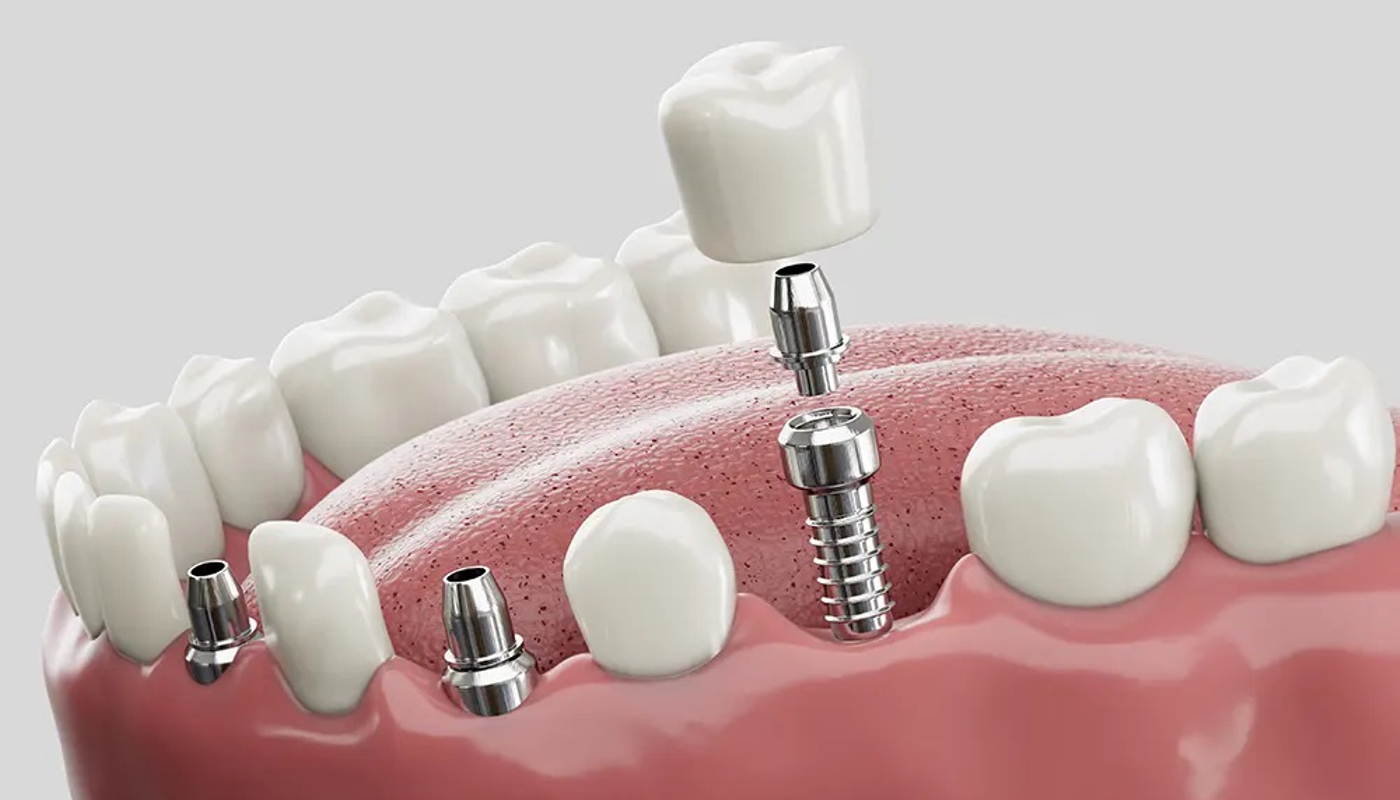 Odontoiatria conservativa